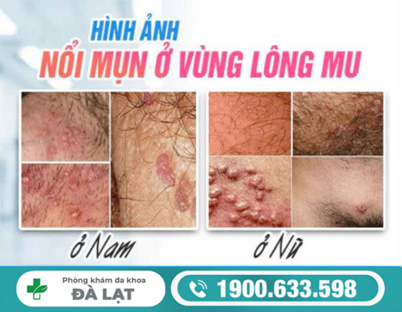 Hình ảnh minh họa